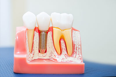 Spectrum Dental | Root Canals, Preventative Program and Digital Radiography