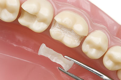 Spectrum Dental | ZOOM  Whitening, Dental Bridges and Periodontal Treatment