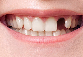 The image displays a close-up of a person s smile, showing white teeth and a partial tooth replacement in the upper left area.