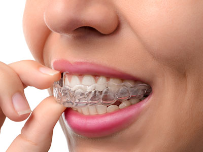 The image shows a person wearing a clear aligner, which is used for orthodontic treatment to straighten teeth.