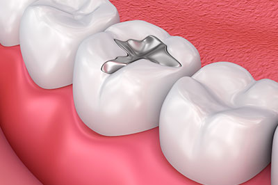 An image of a dental implant being screwed into a prepared tooth socket, set against the backdrop of a dental implant abutment and a partial denture framework.