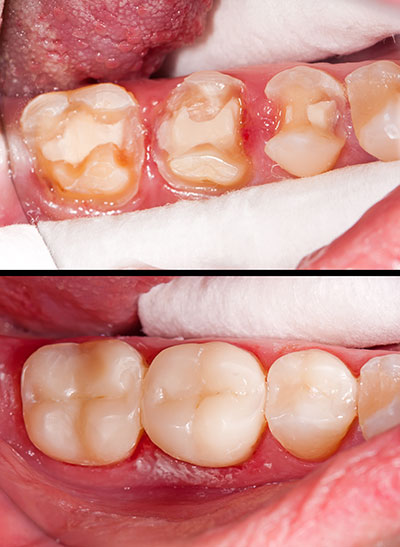 The image displays a person s mouth with severe dental decay and discoloration, showcasing the need for extensive dental care.