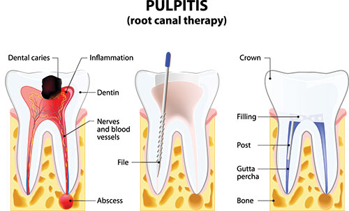 The image is a medical illustration showing the anatomy of a tooth and its root canal, with labels indicating various parts such as dental caries, inflammation, filling, abscess, and gums.