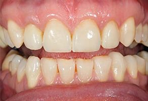 The image shows a close-up of a person s teeth with yellow staining, likely from smoking or other causes.