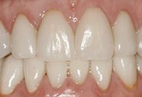 The image shows a close-up view of a person s teeth, with the focus on a gap between two front teeth that appear to be missing or have been removed.