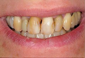 The image shows a person with a yellowish-brown discoloration on their teeth, which is likely the result of dental staining or decay.